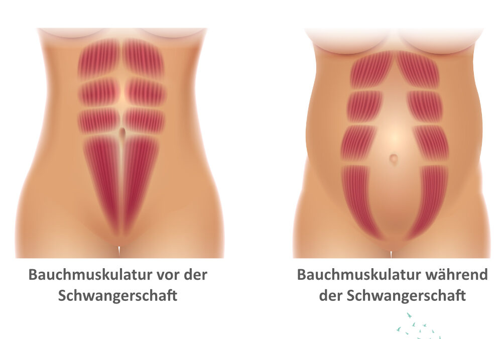 Was ist die Rektusdiastase? Thema Bauchmuskulatur: