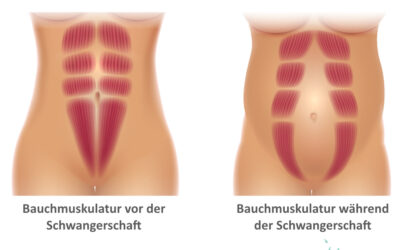 Was ist die Rektusdiastase? Thema Bauchmuskulatur: